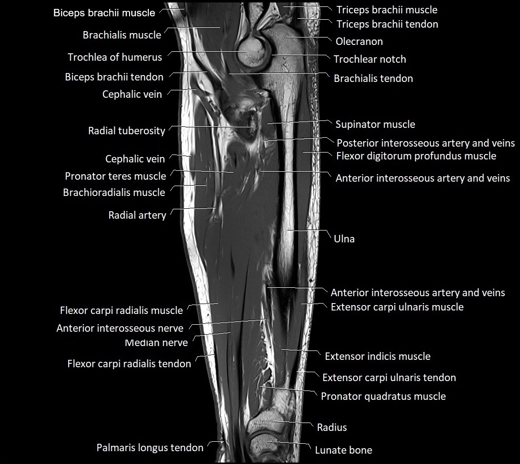 MRI 3T forearm sagittal labelled cross sectional anatomy image 22.webp